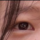 여우꼬리 | 눈밑지방재배치 내돈내산 후기_여우눈, 붓기 경과 후기