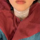 꼴보기 싫은 목주름제거 메이크 자가진피재생술 압구정성형외과 두달후 3차 시술 솔직후기