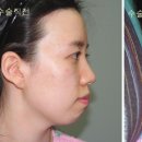 서울제일성형외과의원 네이버블로그