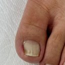 레푸스인하대역점 내성발톱 무좀발톱 발각질 문제성발 이미지