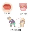 베체트 병[Behcet's disease]근골격질환, 피부질환 이미지