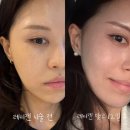 (YOUNG)콜라겐 | 연산동 피부과 부산 레티젠 , 미간 이마 보톡스 맞은 후기 및 붓기 멍 경과