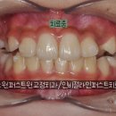 퍼스트원치과의원 | 초등 3학년 "인비절라인 퍼스트" 치료 케이스