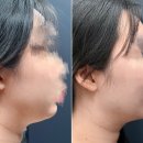 V라인S라인 | [전주 다이어트] V라인 만들기, 이중턱 고민 끝낸 S핏 후기