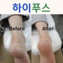 춘천 발각질 관리 하이푸스 춘천온의점 | 내성발톱 무좀 관리 전문샵
