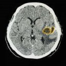 卍 ▶…뇌 질환 의심될 땐?...저렴한 CT vs 비싼 MRI 이미지