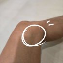 달리기 부상 신스프린트 후기 척척박사한의원