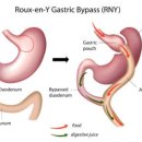 bypass (바이패스, 우회술, (막혀서 다른 쪽으로) 빼뿌써) 어원 이미지