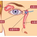 눈물점 빼야할까요? 이미지
