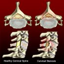 ﻿척추관 협착증 (spinal stenosis) 이미지