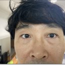 강남미의원 | 강남역미의원 눈밑필러하나로 분위기가 바뀌었어요