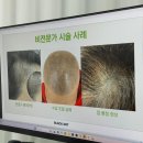 블랙아트 미사점 :: 하남smp전문점 | 신경쓰이던 정수리커버 1회차 시술 후기