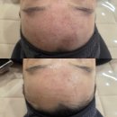 성복플라자 | 용인 수지 성복역 피부관리 애몽스킨케어 여드름관리 후기