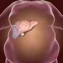 지방간의 진단과 관리 이미지