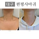 마음심한의원 | 대구 편평사마귀 한의원 목 거우침 치료 3주 솔직후기