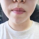 천사의료기 | [인천]송도 피부과 리니어지 리프팅 600샷 효과 턱끝 입꼬리 보톡스 필러 후기