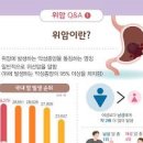 위암 초기 원인 예방 이미지