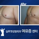 흉터걱정 없는 유륜밑 절개 실루엣 성형외과 여유증 수술 이미지