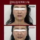 플랜비뷰티(Plan_B_Beauty) | 순천 웨딩 촬영 전 필수 관리! 땅콩형 얼굴 윤곽 교정으로 V라인 완성
