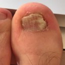 오래하는약국 | 약국 주블리아 무좀약 추천 사용법 최종 후기