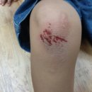 ＜선반 백민규, 전현준＞ 공터에서 놀이하다가 부딪혀서 넘어져 무릎에 상처가 남. 이미지