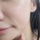 하늘그린약국 | 약국 피부재생크림 10회차의 레이저 재생크림 추천