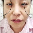 압구정 리프팅 인어젯 받고 리즈시절 돌아간 내돈내산 솔직후기