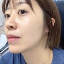 젤란사 | 스킨부스터 포젤란 실펌엑스 한달 후기 통증 언주역피부과