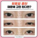 뒷트임 흉터 자국 가득한 뒤트임 후기, 피하고 싶을 때 이미지