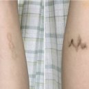 연세스타피부과의원 | [신촌 연세스타피부과] 홍대, 신촌 타투 제거 3회차 내돈내산 후기 + 한달 후기!!