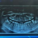 부강 강치과의원 | 30대 치아교정 후기 (2) - 비발치 교정 시작, 볼패임, 사랑니발치, 스크류, 교정부작용