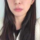 미주광택 | 수원 스킨부스터 4회차 3개월차 솔직후기