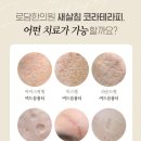 새대구한의원 | 대구 [로담한의원] 새살침/코라테라피/여드름 흉터치료/1회차 후기 추천