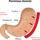Vitamin B12 결핍증 이미지