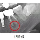 치근낭[Radicular cyst]치과질환 이미지
