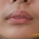양평믿음치과의원 | 양평교정치과 학업에 바쁜 중학생의 튀어나온 이 교정 후기