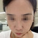 본피부과의원 | 가양역 피부과 콜라겐 스킨부스터 올리디아, 뷰커스의원에서 받아본 후기