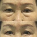 의령병원 | [함안의령하안검수술] 부작용 최소화 | 자연스러운 눈밑하안검 방법