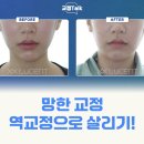 듀오치과의원 | "무턱, 돌출입"고민 역교정으로 시원하게 해결!