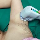 아산 미래메디칼 미라드라이후기 (프레쉬)