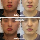 선교정치과기공소 | 수술 없이도 효과보는 안면 비대칭 교정 방법