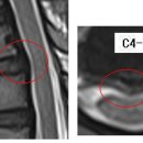 lica 님의 경추디스크 C4-5의 MRI사진 판독입니다.(두번째) 이미지