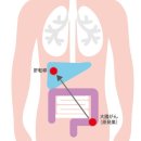 대장암에서 간으로 전이가 되는 확율 30% ​ 이미지