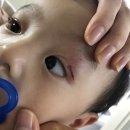 양산대학약국 | 11개월아기, 아기 눈 주위 찢어짐, 눈 옆 찢어짐, 6-8바늘 봉합, 동래 수의원, 24시간, 응급성형외과, 울산