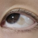 아이유안과의원 | 아이유와 수지도 했던 결막모반 제거! 눈 점, 흰자 점, 눈알 점 제거 후기