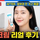 아젤리아 | 피부과 안 가고 해결? 아젤리아크림 리얼 후기