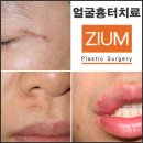 청담지움성형외과의원 | 얼굴흉터치료 하고 자신감도 UP 시켜보자