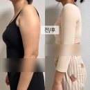 맘편한 동물약국 | 팔지방흡입후기 수술 당일부터 10일차 (준비물, 통증, 멍)