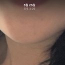 티디 | 다이소 흔적 크림 바이 오디-티디 블레미쉬 트리트먼트 솔직 후기! 찐 효과 봄