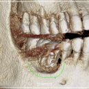 죽전바른신경과의원 | 성복역치과 임플란트잘하는곳? 수술보다 중요한 건 따로 있습니다